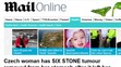 Obří nádor z Česka na DailyMailu