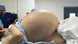 Lékaři ženě vyoperovali 33kilovou cystu - 1