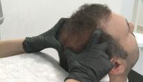VIDEO: Lidé mají mnohem větší zájem o transplantaci vlasů. Nejlevněji vyjde v Turecku