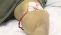V Česku se šíří žloutenka typu A. Nejvíce postižený je Moravskoslezský kraj