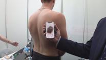 Melanomů v Česku přibývá. Lidé by neměli podcenit lékařskou kontrolu