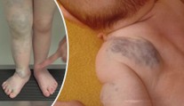 Nová léčba genetické mutace. Na nemoc zabírají léky proti rakovině