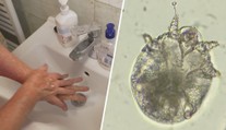 V Česku řádí svrab. Pacientů je nejvíce za posledních 30 let, čtyři zemřeli