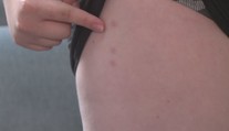Dětskou ozdravovnu zaplavily štěnice. Jejich vyhlazení stálo statisíce