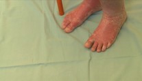 Lupénka trápí čtvrt milionu Čechů. Pomoct může hubnutí