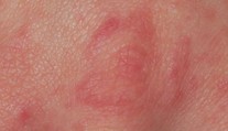V Humpolci se mezi dětmi rozšířil svrab. Platí přísná hygienická opatření