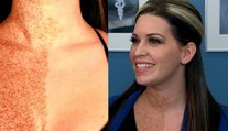 Žena má pihy jen na polovině těla! Lékaři konečně zjistili proč