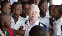 V Malawi vraždí albíny. Lidé věří, že má jejich tělo magickou moc