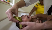 Potvrzeno: Virus zika způsobuje mikrocefalii! Na vakcíně se pracuje