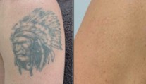 Jak se zbavit nechtěného obrázku? Nově vám tetování odstraní během pár minut