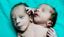 Matka v Indii si myslela, že čeká dvojčata. Porodila dítě se dvěma hlavami