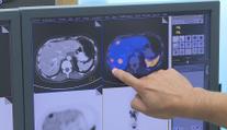 Lékař varuje před přehlíženou rakovinou. Jeden symptom nesmíte ignorovat