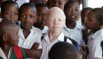 V Malawi vraždí albíny. Lidé věří, že má jejich tělo magickou moc
