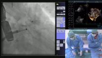 V Brně operovali muži srdce při vědomí. Vše sledoval na 3D obraze