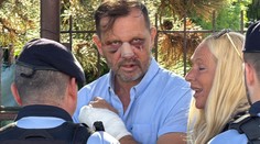 Šokující fotky Jaromíra Soukupa. Po rvačce s Dopitou má úplně rozbitý obličej