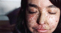 Děsivá nemoc: Andrea chodí ven jen v noci. Slunce by ji zabilo