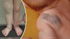 Nová léčba genetické mutace. Na nemoc zabírají léky proti rakovině