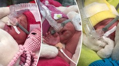 Ostravská trojčata chtěla na svět předčasně. Budou v pořádku