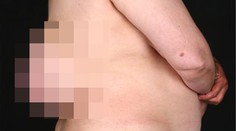 Ženě vyrostlo na zádech "třetí prso"! Nechala ho růst 10 let