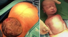 Zázrak zrození v přímém přenosu: Miminko samo vylezlo z břicha!