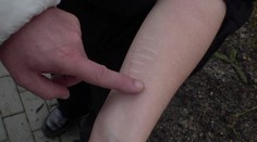 Nože nebo nůžky. Desítky tisíc dětí se sebepoškozují, jejich počet strmě roste