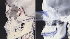 Znovu se narodil! Mladík přežil nůž bodnutý do oka. Dokonce vidí!