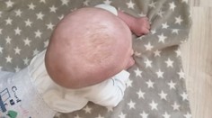 Obří boule na hlavě ničí miminku život. Ortézu pojišťovna neproplatí