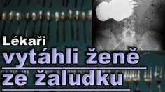 Lékaři vytáhli ženě ze žaludku 78 lžiček a vidliček