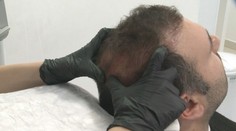 Lidé mají mnohem větší zájem o transplantaci vlasů. Nejlevněji vyjde v Turecku