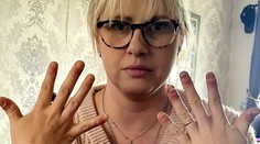 FOTO: Žena léta nosila gelové nehty. Teď toho hořce lituje