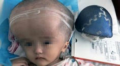 Dívenka měla obří hlavu. Novou lebku jí vyrobili na 3D tiskárně