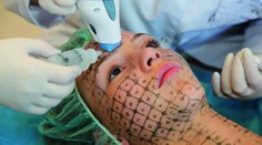 Světově uznávaná metoda Thermage umožňuje omládnout bez plastické operace