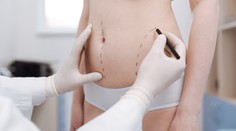 Sen o dokonalých křivkách: Vše o liposukci a tvarování těla
