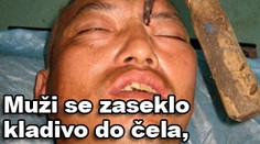 Muži se zaseklo kladivo do čela, ale přežil