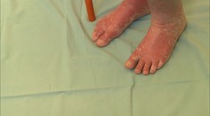 Lupénka trápí čtvrt milionu Čechů. Pomoct může hubnutí