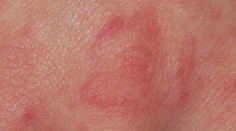 V Humpolci se mezi dětmi rozšířil svrab. Platí přísná hygienická opatření