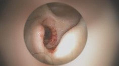 ODPORNÉ VIDEO: Ženu ukrutně bolelo ucho, uvnitř se jí krmili červi!