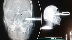 Mám malý problém, řekl muž, který přišel s nůžkami v lebce