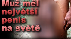 Muž měl největší penis na světě. Už mu ho odoperovali