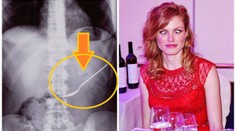 Záhada spolknuté lžičky: Tady je důkaz, že se to Koukalové stalo!