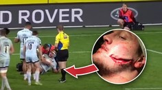 NATRŽENÝ OBLIČEJ. Ragbista ukázal hrůzné zranění! VIDEO