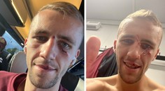 Nikdy se nevzdám, uklidnil fanoušky Tomáš Souček a ukázal sešitý obličej
