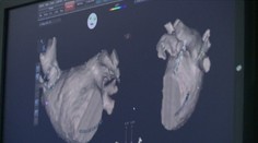 Čeští lékaři mají unikátní metodu: Při operaci vytvoří 3D obraz srdce!