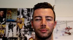 Hokejistu Jihlavy zbaběle napadla parta lidí! Hlinka má otřes mozku