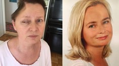 Dovolená v Česku jí zničila život i vzhled. Ženě (52) odstranili část lebky
