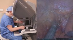 Lékaři operují častěji pomocí robotů. Důvodem je přesnost zákroků