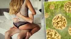 Pohlavní choroby se šíří Českem! Syfilis už je na hranici epidemie