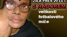 Žila přes 20 let s nádorem velikosti fotbalového míče