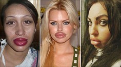 FOTO: Tyhle ženy to přehnaly s operací rtů! Líbí se vám to ještě?