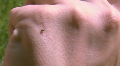 Nakažených kvůli klíšťatům dál přibývá! "Bude hůř," tvrdí epidemiolog
